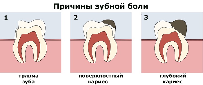 Причины зубной боли - травма зуба и кариес