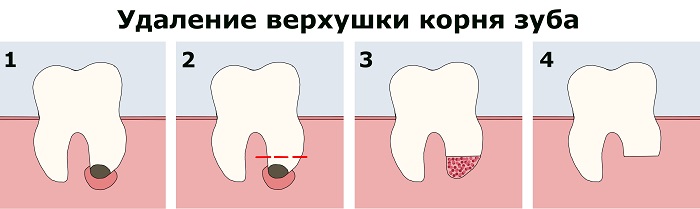 Резекция верхушки корня зуба - схема операции по удалению корня