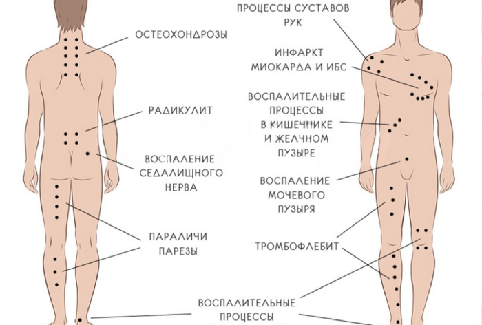 Распределение активных точек на теле человека, используемые в гирудотерапии